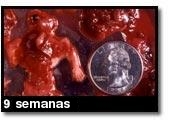 Foto de um aborto - 9 semanas